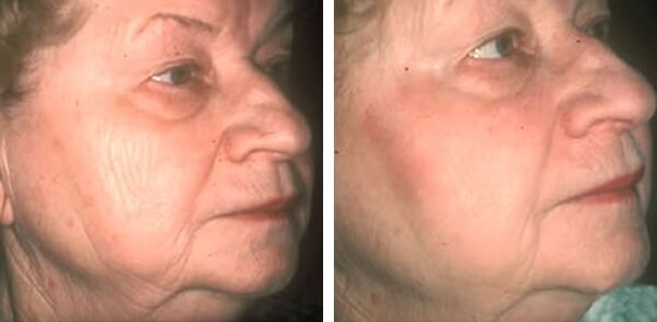 before and after laser skin rejuvenation photo 4