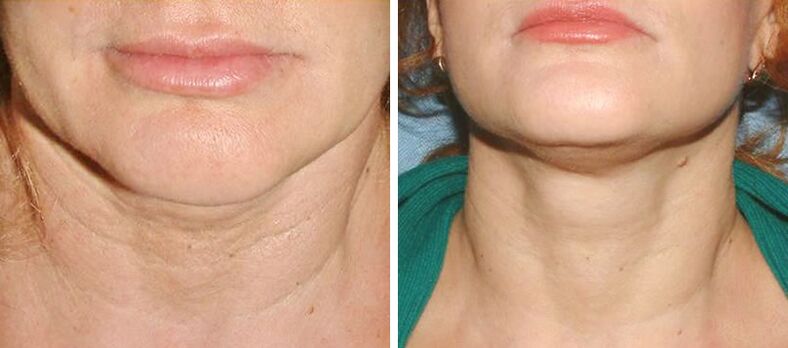 before and after laser skin rejuvenation, photo 2