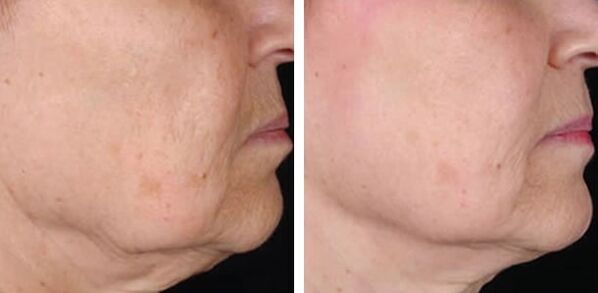 before and after laser skin rejuvenation, photo 3