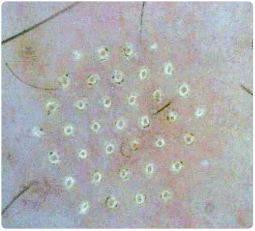 skin under a microscope after fractional rejuvenation