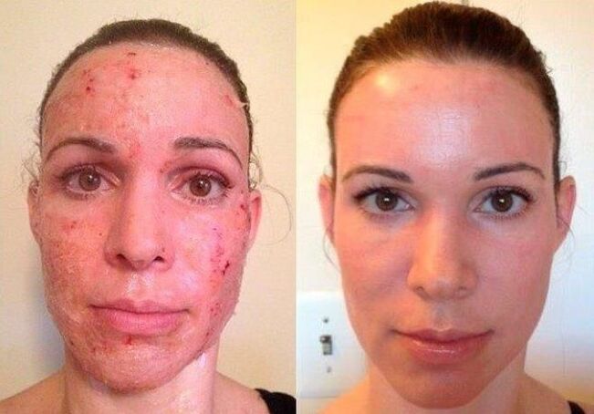 before and after fractional skin rejuvenation photo 1