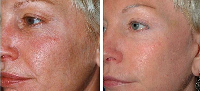 before and after fractional skin rejuvenation photo 4