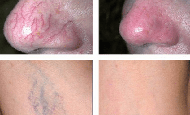 Photothermolisis