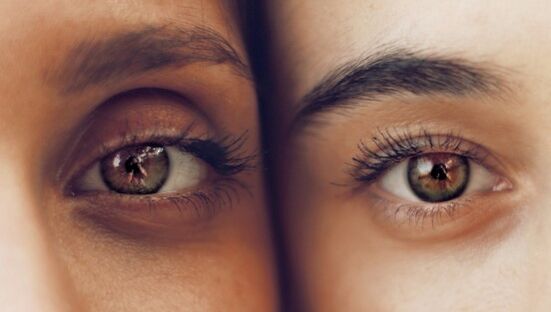 Sweet circles under the eyes